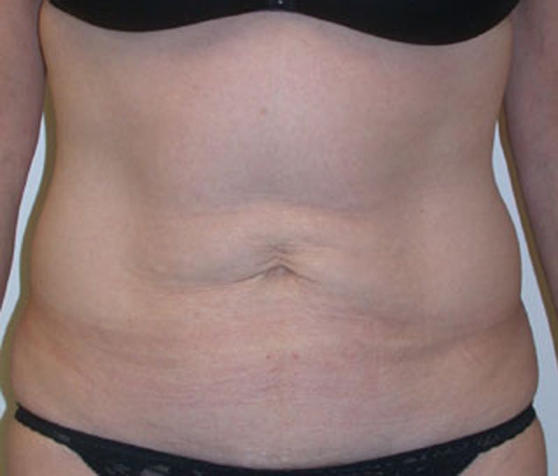Tummy Tuck Before & After Gallery - Patient 174166672 - Image 1