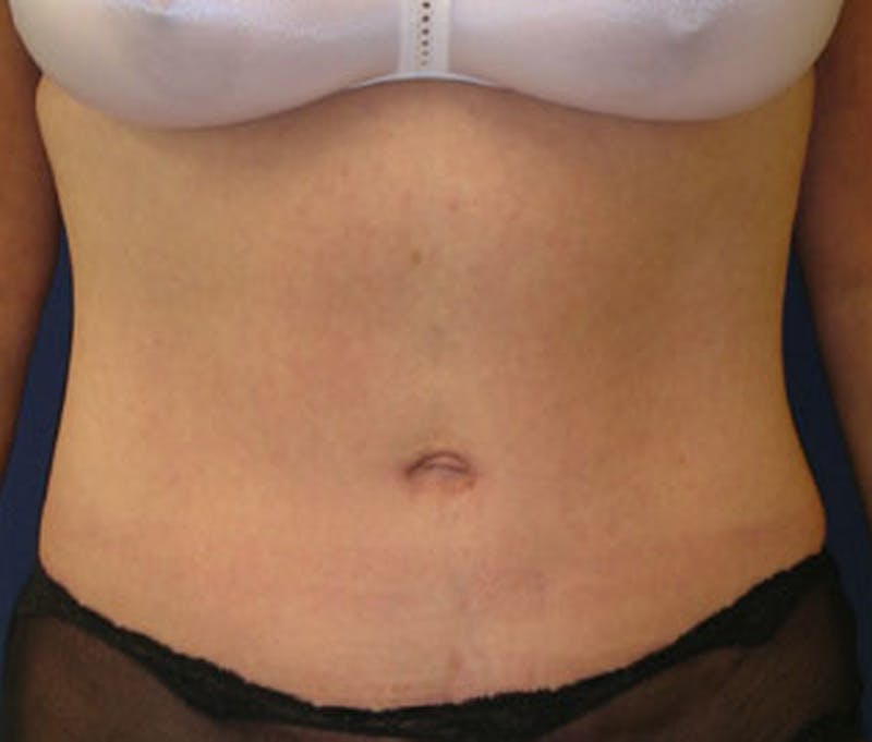 Tummy Tuck Before & After Gallery - Patient 174166672 - Image 2