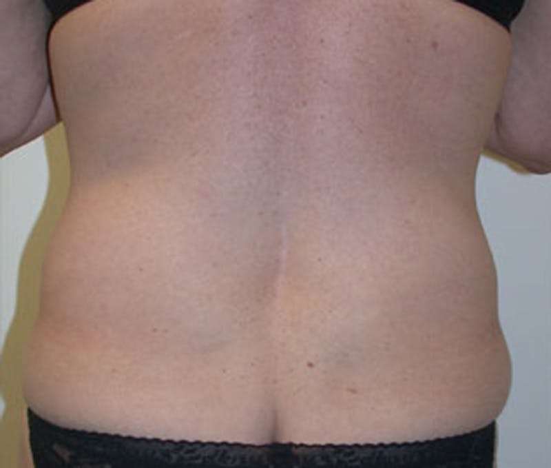 Tummy Tuck Before & After Gallery - Patient 174166672 - Image 3