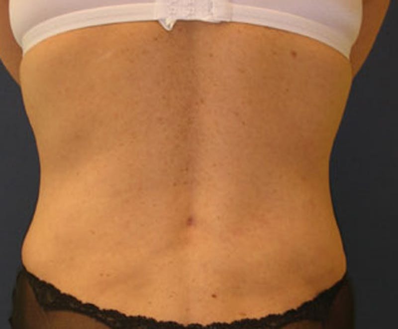 Tummy Tuck Before & After Gallery - Patient 174166672 - Image 4