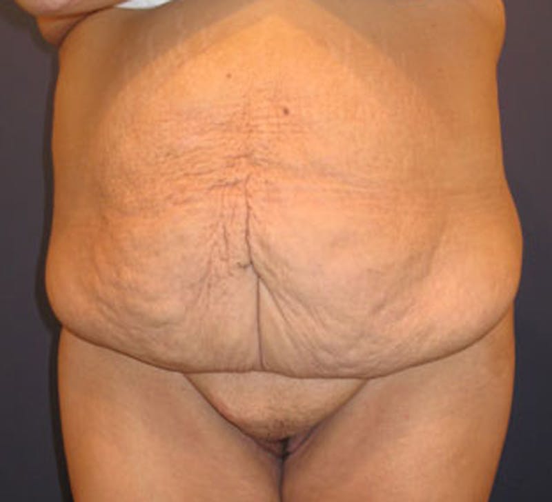 Tummy Tuck Before & After Gallery - Patient 174166673 - Image 1