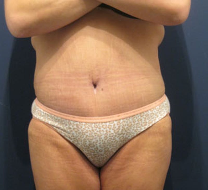 Tummy Tuck Before & After Gallery - Patient 174166673 - Image 2