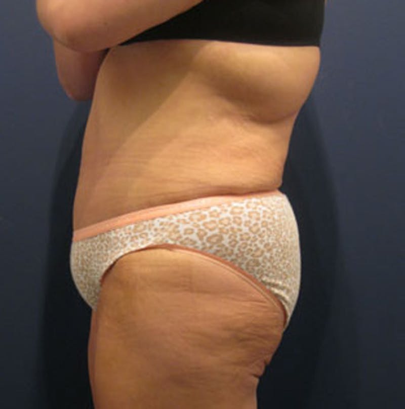 Tummy Tuck Before & After Gallery - Patient 174166673 - Image 4
