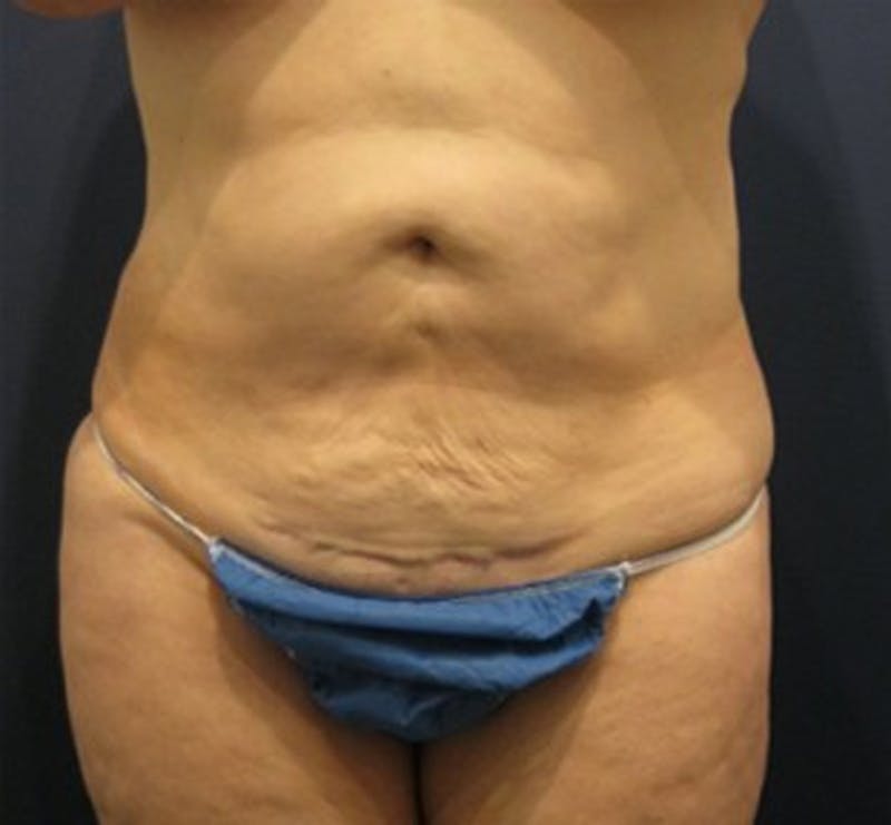 Tummy Tuck Before & After Gallery - Patient 174166675 - Image 1