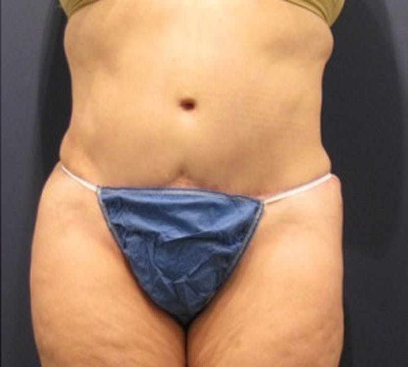 Tummy Tuck Before & After Gallery - Patient 174166675 - Image 2