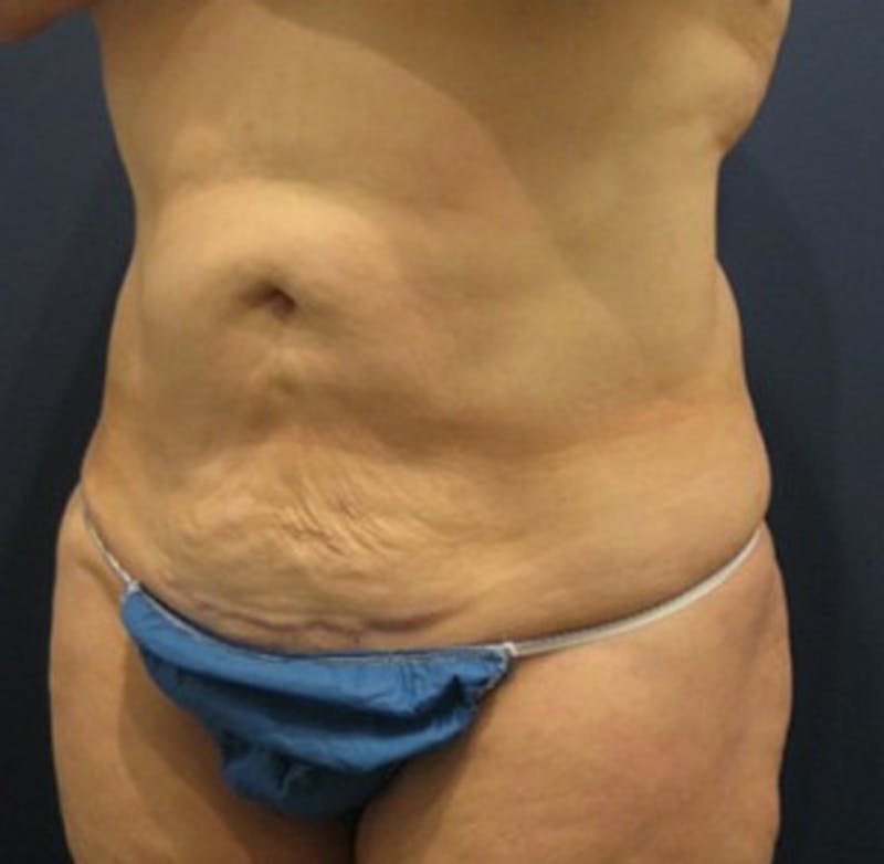 Tummy Tuck Before & After Gallery - Patient 174166675 - Image 3