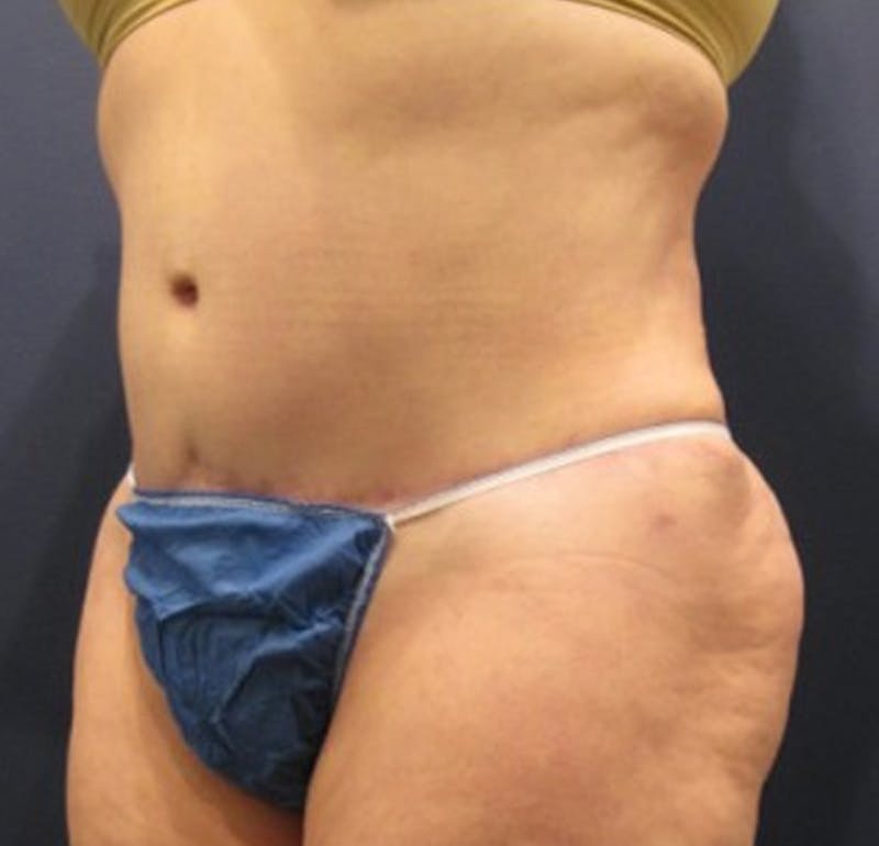 Tummy Tuck Before & After Gallery - Patient 174166675 - Image 4