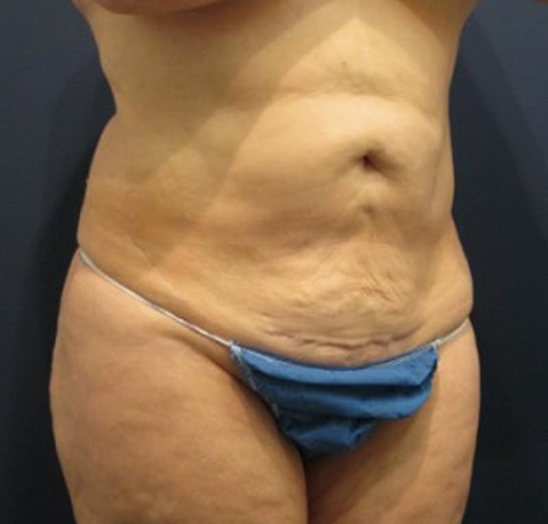 Tummy Tuck Before & After Gallery - Patient 174166675 - Image 5