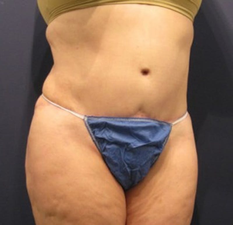 Tummy Tuck Before & After Gallery - Patient 174166675 - Image 6