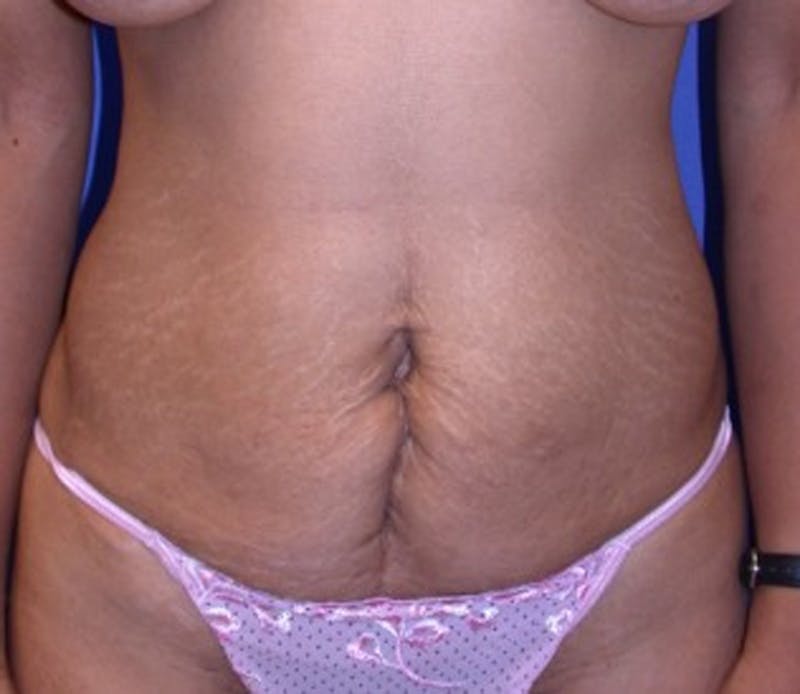Tummy Tuck Before & After Gallery - Patient 174166677 - Image 1