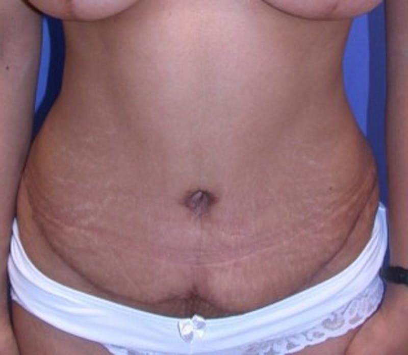 Tummy Tuck Before & After Gallery - Patient 174166677 - Image 2