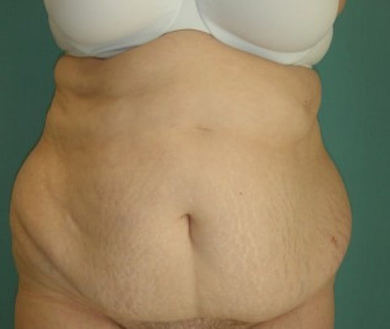 Tummy Tuck Before & After Gallery - Patient 174166679 - Image 1