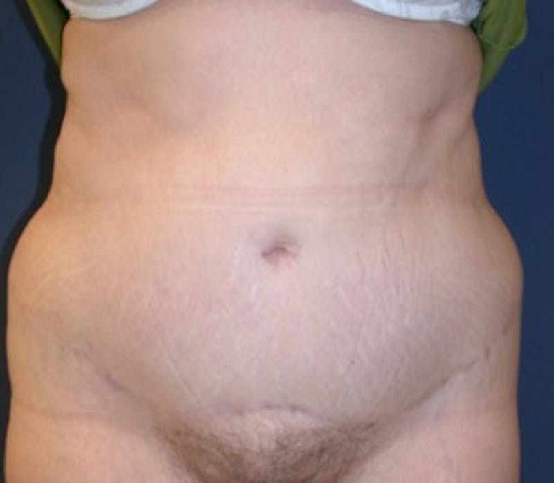 Tummy Tuck Before & After Gallery - Patient 174166679 - Image 2