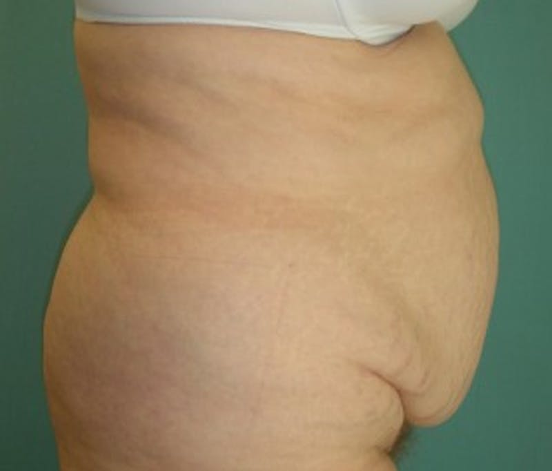 Tummy Tuck Before & After Gallery - Patient 174166679 - Image 3