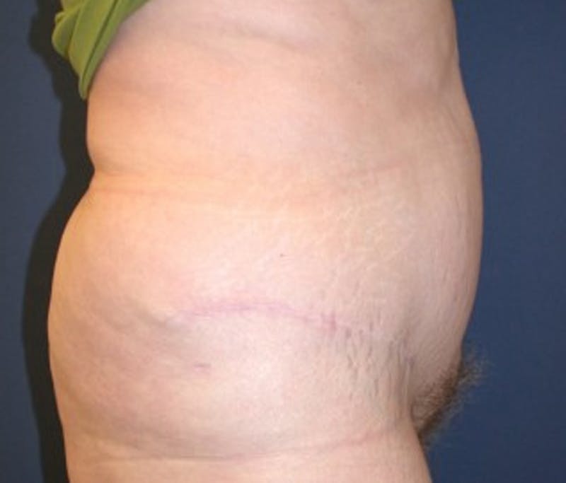 Tummy Tuck Before & After Gallery - Patient 174166679 - Image 4