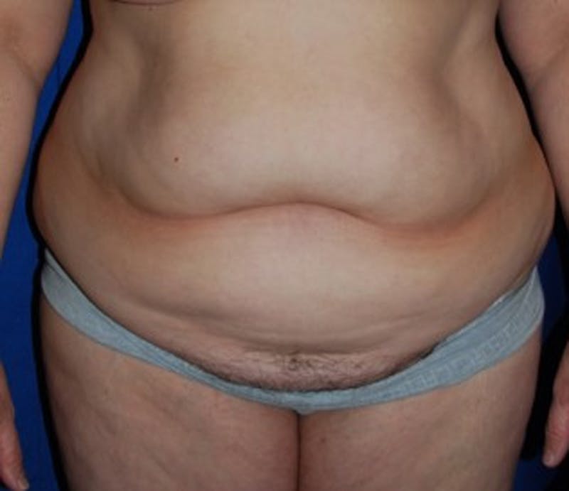 Tummy Tuck Before & After Gallery - Patient 174167752 - Image 1