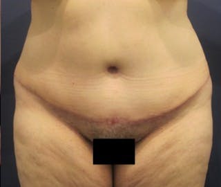 Tummy Tuck Before & After Gallery - Patient 174167752 - Image 2