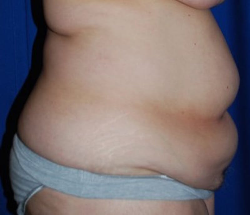 Tummy Tuck Before & After Gallery - Patient 174167752 - Image 3