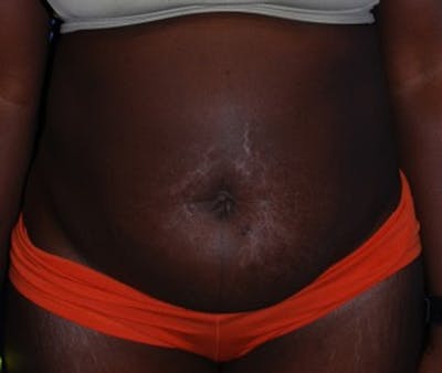 Tummy Tuck Before & After Gallery - Patient 174172754 - Image 1