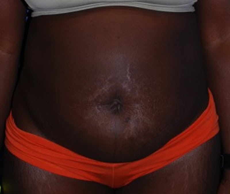 Tummy Tuck Before & After Gallery - Patient 174172754 - Image 1