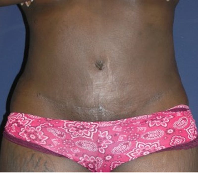 Tummy Tuck Before & After Gallery - Patient 174172754 - Image 2