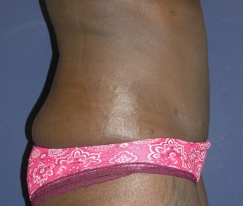 Tummy Tuck Before & After Gallery - Patient 174172754 - Image 4