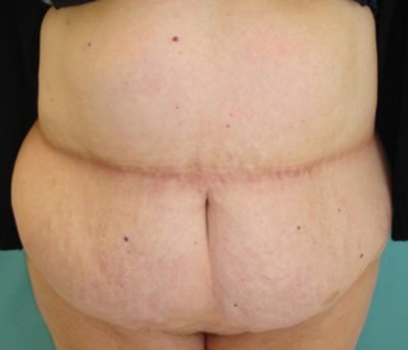 Tummy Tuck Before & After Gallery - Patient 174178656 - Image 1