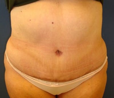 Tummy Tuck Before & After Gallery - Patient 174178656 - Image 2