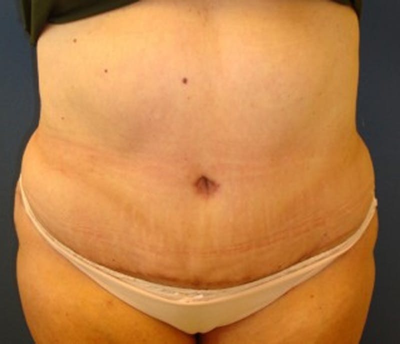 Tummy Tuck Before & After Gallery - Patient 174178656 - Image 2