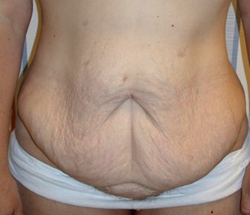Tummy Tuck Before & After Gallery - Patient 174178657 - Image 1