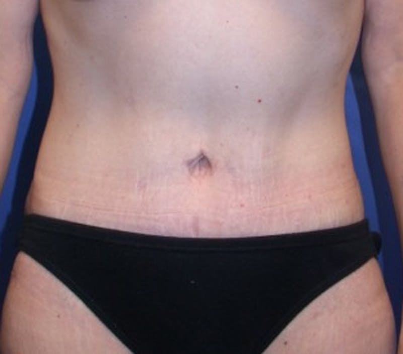 Tummy Tuck Before & After Gallery - Patient 174178657 - Image 2
