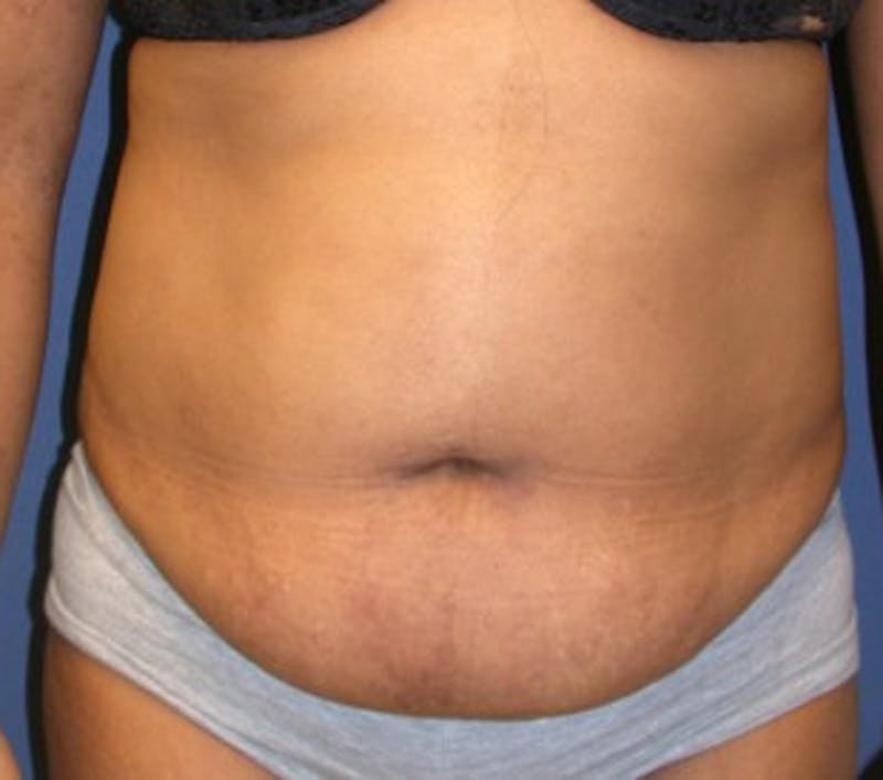 Tummy Tuck Before & After Gallery - Patient 174178658 - Image 1