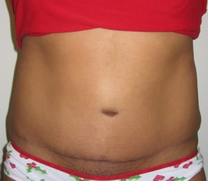 Tummy Tuck Before & After Gallery - Patient 174178658 - Image 2