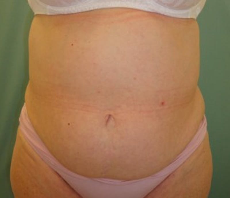 Tummy Tuck Before & After Gallery - Patient 174178659 - Image 1