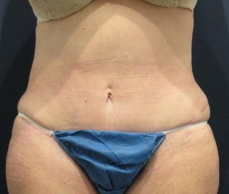 Tummy Tuck Before & After Gallery - Patient 174178659 - Image 2