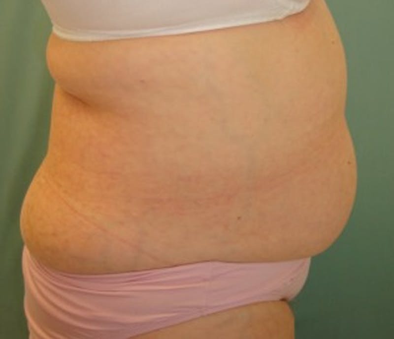 Tummy Tuck Before & After Gallery - Patient 174178659 - Image 3