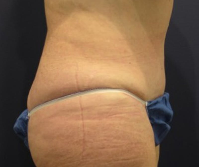 Tummy Tuck Before & After Gallery - Patient 174178659 - Image 4