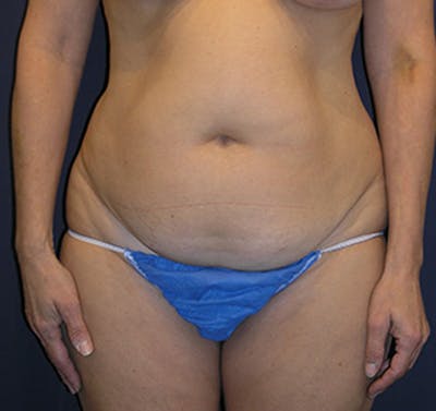 Tummy Tuck Before & After Gallery - Patient 174178661 - Image 1