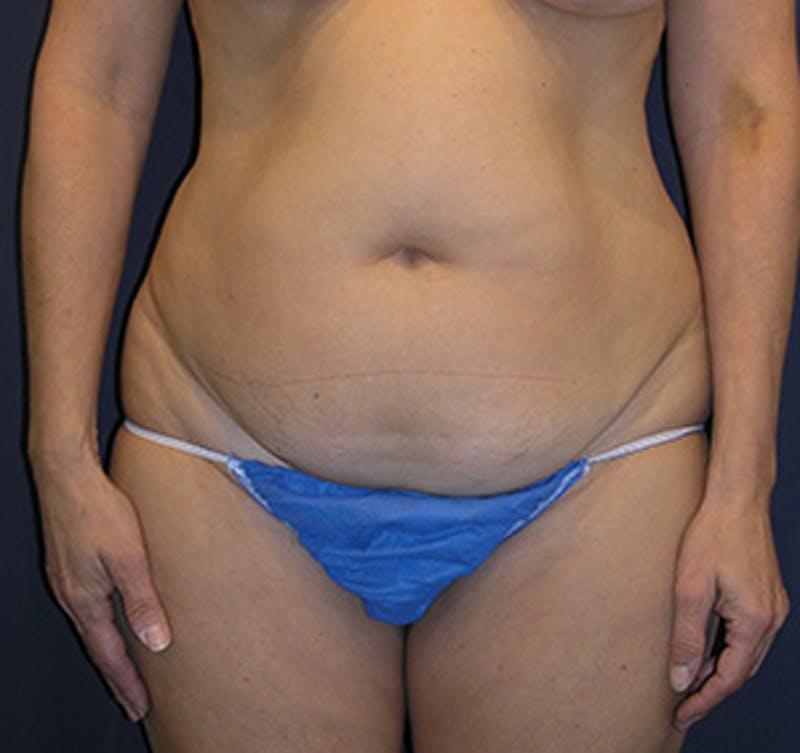 Tummy Tuck Before & After Gallery - Patient 174178661 - Image 1