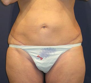 Tummy Tuck Before & After Gallery - Patient 174178661 - Image 2