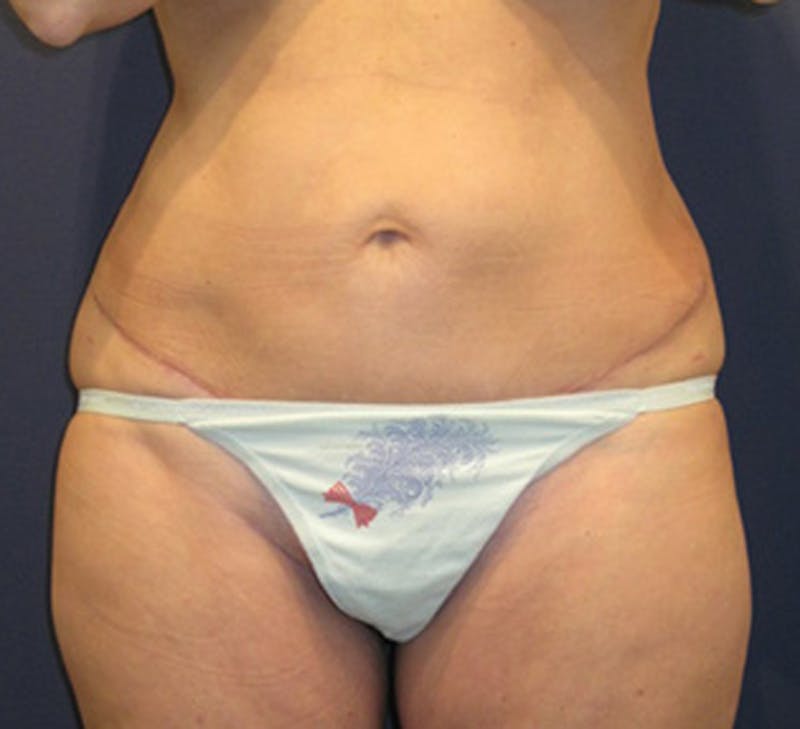 Tummy Tuck Before & After Gallery - Patient 174178661 - Image 2