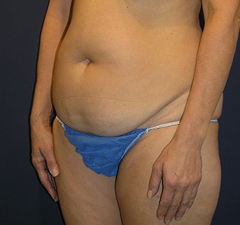 Tummy Tuck Before & After Gallery - Patient 174178661 - Image 3