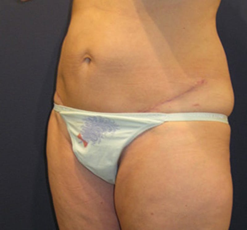 Tummy Tuck Before & After Gallery - Patient 174178661 - Image 4
