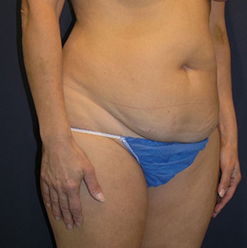 Tummy Tuck Before & After Gallery - Patient 174178661 - Image 5