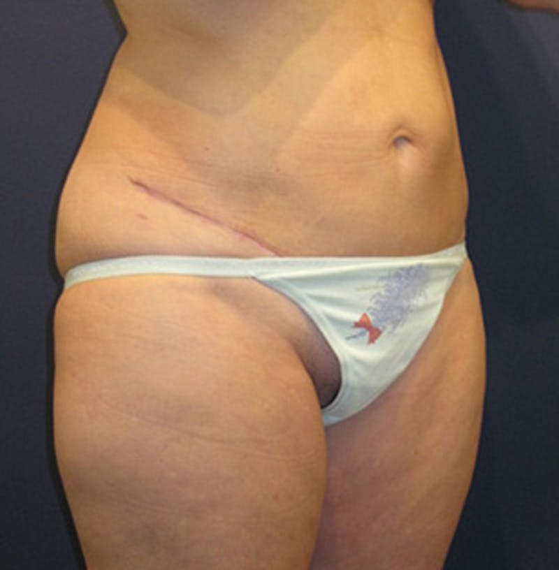Tummy Tuck Before & After Gallery - Patient 174178661 - Image 6