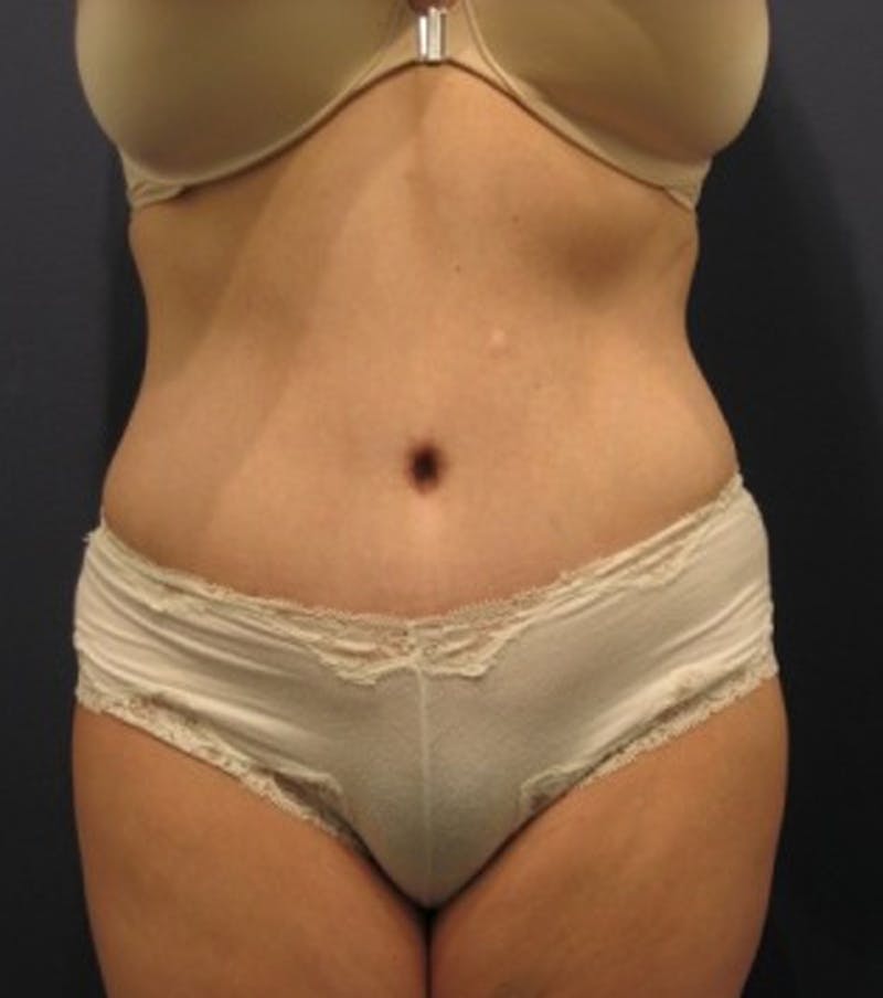 Tummy Tuck Before & After Gallery - Patient 174178662 - Image 2