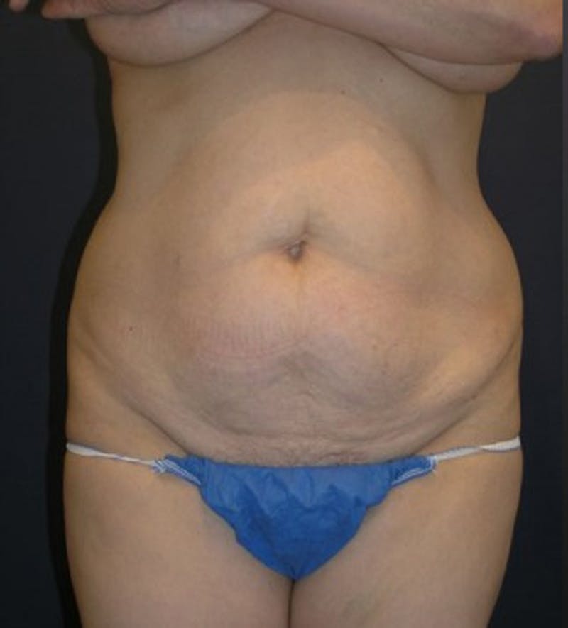 Tummy Tuck Before & After Gallery - Patient 174178662 - Image 1