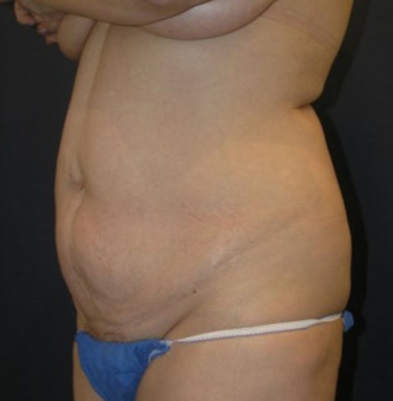 Tummy Tuck Before & After Gallery - Patient 174178662 - Image 3