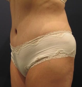 Tummy Tuck Before & After Gallery - Patient 174178662 - Image 4