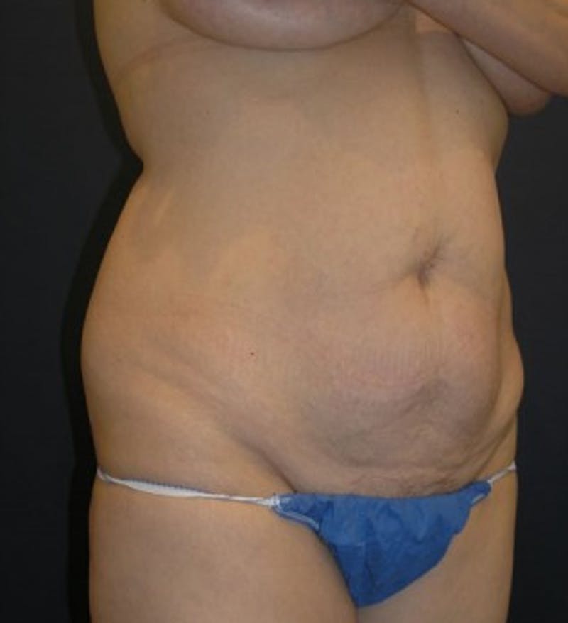 Tummy Tuck Before & After Gallery - Patient 174178662 - Image 5